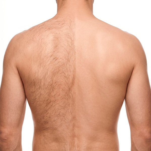 antes y después depilación láser espalda hombre