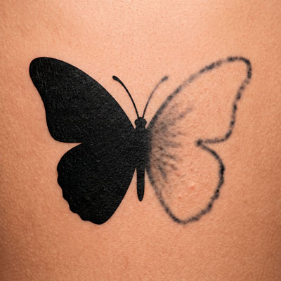 eliminacion de tatuajes miniatura