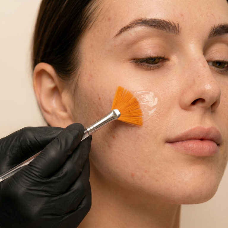 tratamiento acne baena v de milo